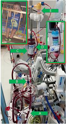 Case Report: Successful Use of Extracorporeal Therapies After ECMO Resuscitation in a Pediatric Kidney Transplant Recipient